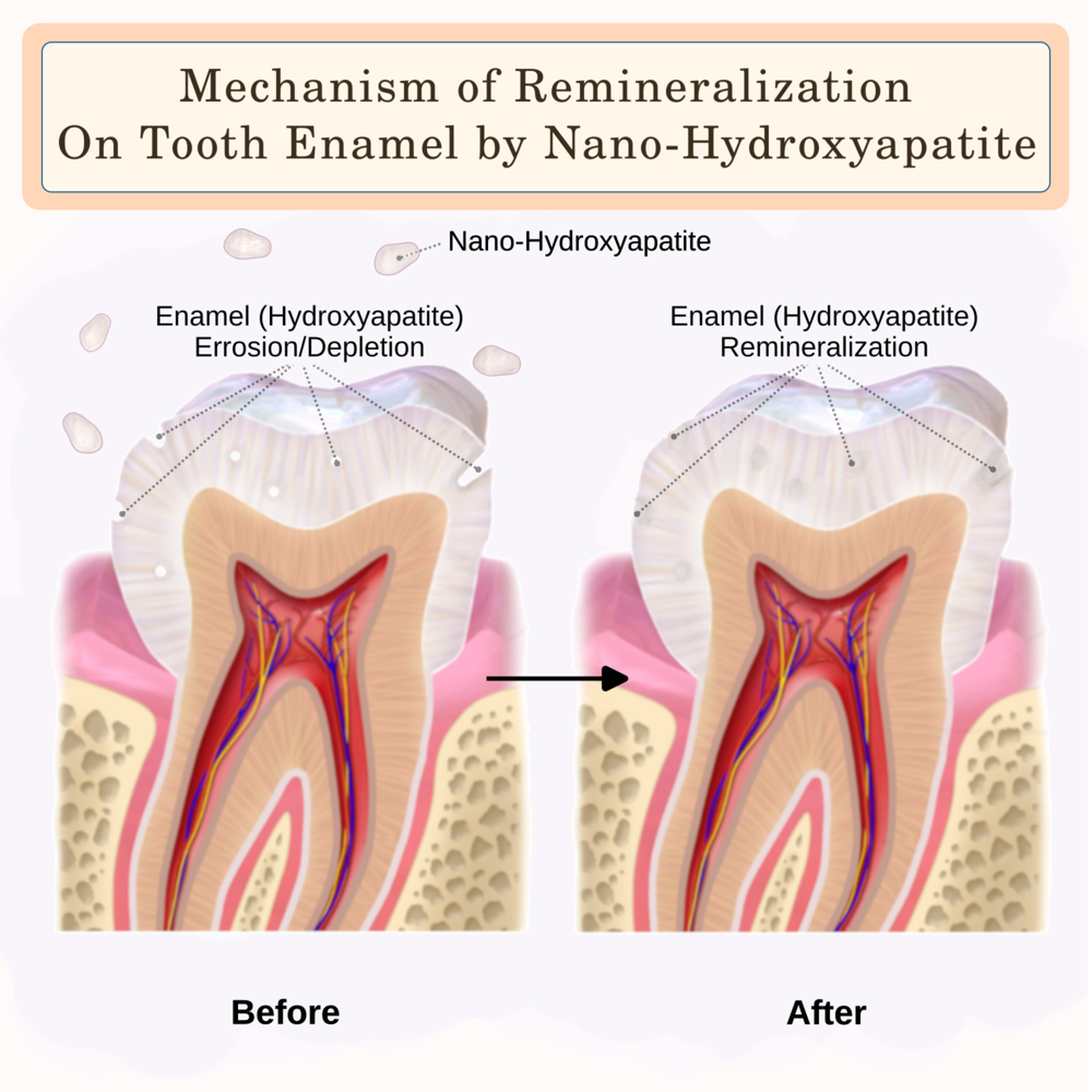 Mechanism of Remineralization on Tooth Enamel by Nano-Hydroxyapatite